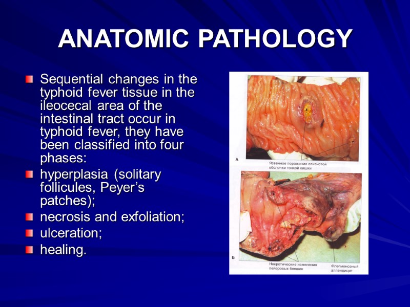 ANATOMIC PATHOLOGY  Sequential changes in the typhoid fever tissue in the ileocecal area